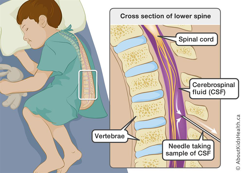 Lumbar Puncture KidsHealth NZ